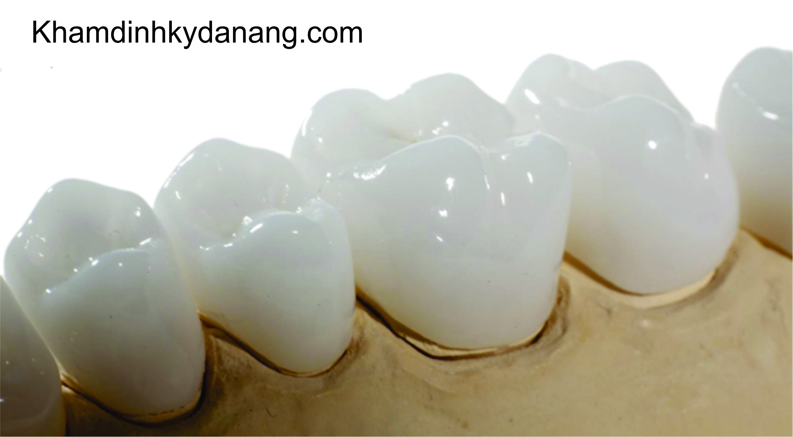 Dentals for porcelain crowns in Danang