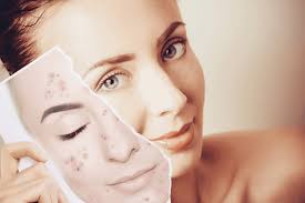 CÁC LOẠI SERUM TRỊ MỤN